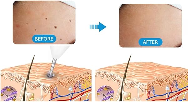 Prague Laser Mole Remover Needle Kit for Skin Tag, Tattoo, Freckle & Dark Spot Removal | 10 Fine Needles, 1 Coarse Needle & 1 Holder | Replacement Needles for Plasma Pen & Spot Removal Device